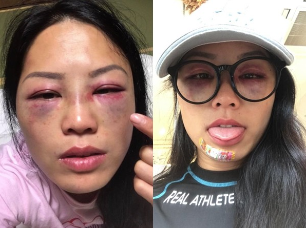 港女星录节目被暴打成“猪头” 双眼瘀血画面曝光