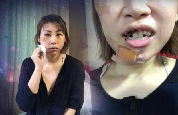 女歌手韩国旅游跌倒撞钢椅毁容  牙齿断裂嘴缝23针