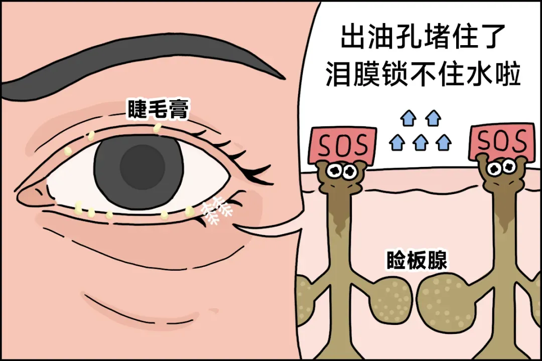 加速眼睛报废的 6 个坏习惯,很多人天天干(不是熬夜!