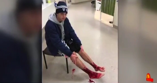 血腥慎入！男孩海边被咬满腿鲜血淋漓 连医生都无法确定准确原因