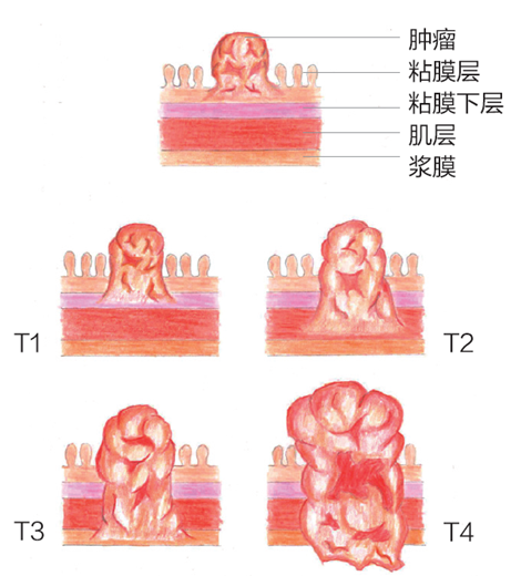 东野圭吾去世，这种癌症正在年轻化，我们该怎么办？
