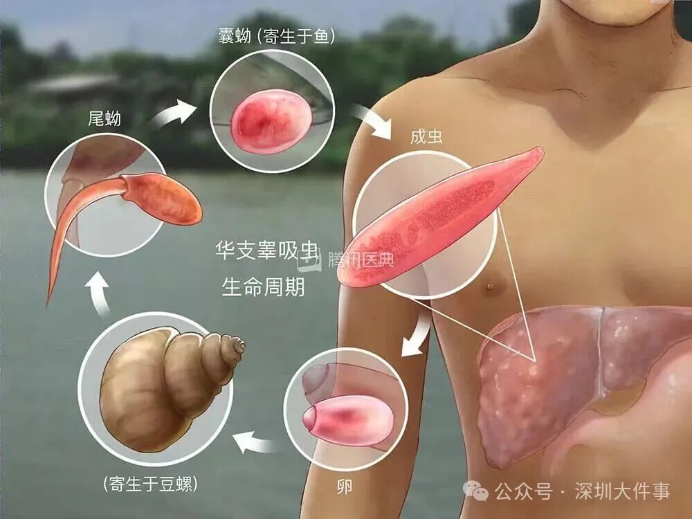 广东人尤其爱吃！高烧10天，女子查出肝功能异常，此前有5人聚餐后全部确诊