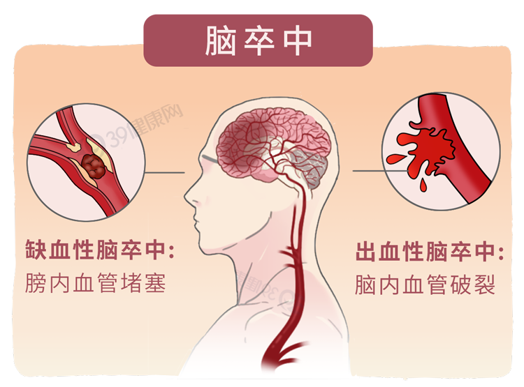 53岁男子突发脑梗去世,医生:晨起不要做2件事,加大脑梗风险