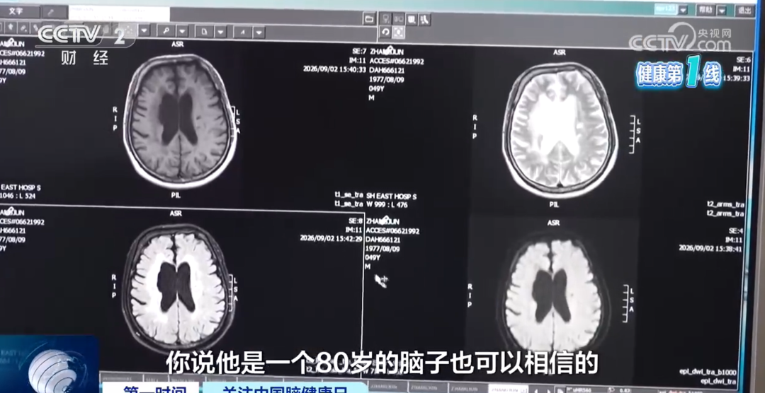 40多岁的人，80岁的大脑！医生：这个加速大脑早衰的习惯，很多人都有
