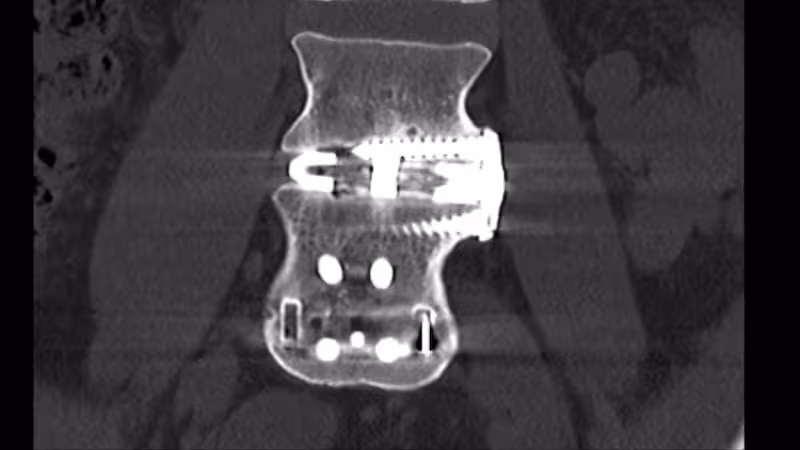 spinal-xray-EYUUJ6PYOVGZXGQTIT5CI3UDMU.jpg