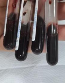 长期吃隔夜饭菜,3岁男孩中毒进PICU
