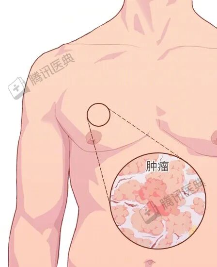 男人很容易忽视的一种癌,确诊大多是晚期