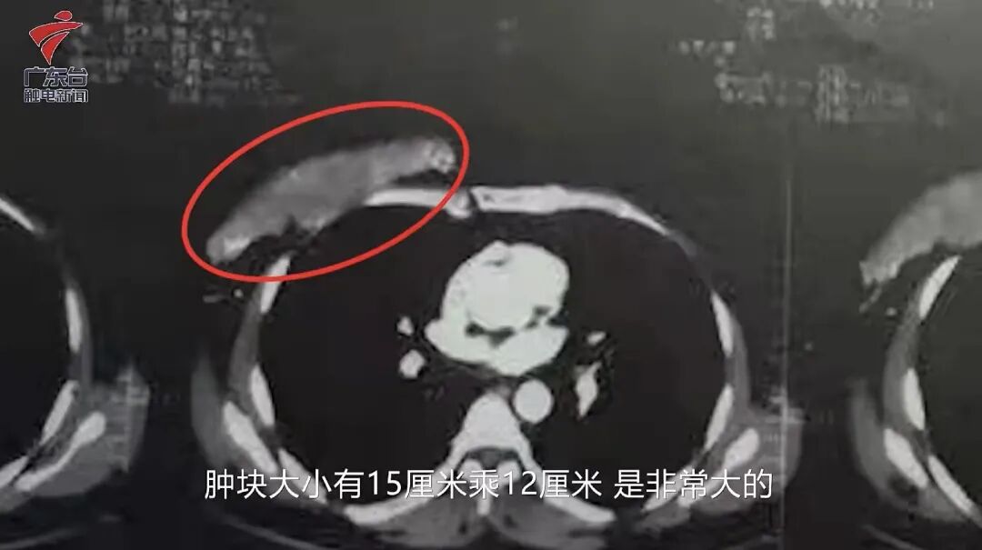 男人很容易忽视的一种癌,确诊大多是晚期